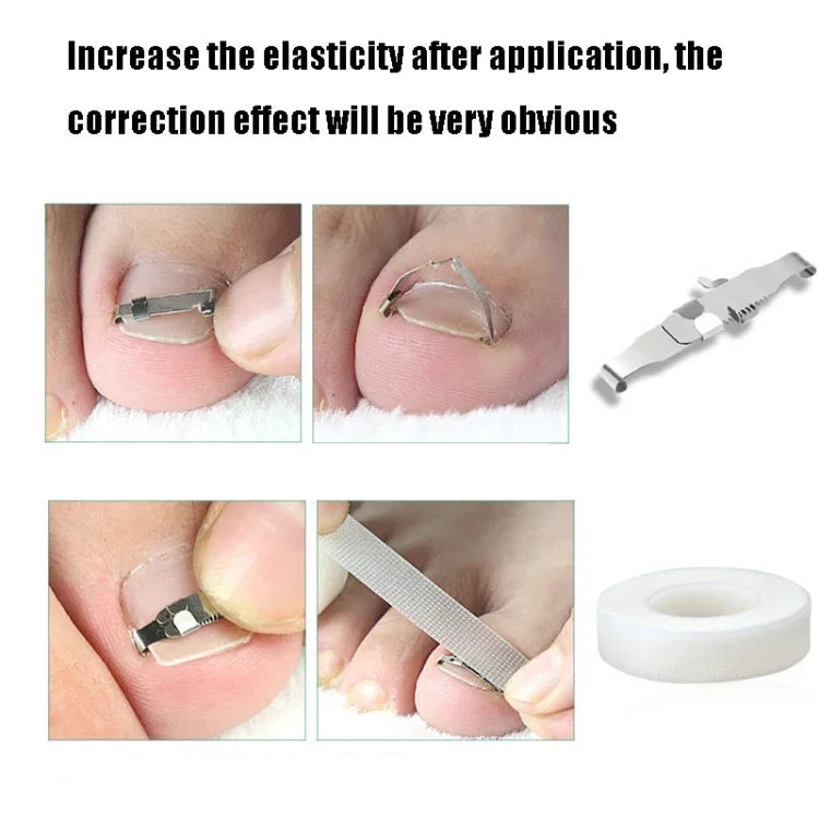 Orthopedic Buckle Toe Nail Groove Ingrown Nail Corrector, No. 36 Positive Nail Buckle, No. 38 Positive Nail Buckle, No. 40 Positive Nail Buckle, No. 42 Positive Nail Buckle, No. 44 Positive Nail Buckle, No. 36 Set, No. 38 Set, No. 40 Set, No. 42 Set   ...